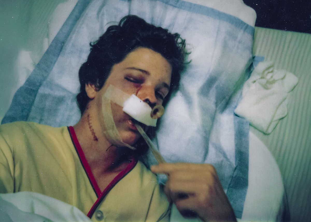 Me - a few days after the surgery.  Note the bugle in my nose, the stitches were on both sides of my neck, and I was still drinking ginger ale through a straw.